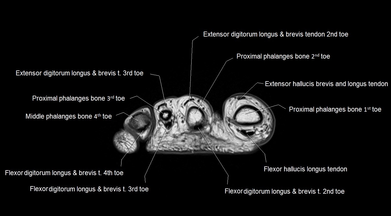 MRI 3T foot axial cross sectional anatomy image 33.webp
